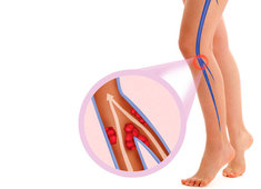 Dia Internacional da Mulher: cuidado com a trombose